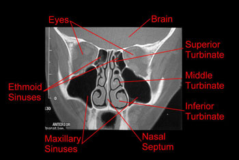 Turbinate cross sectional CT